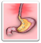 Acid Reflux