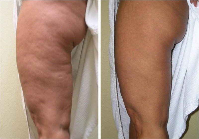 Cellulite Treatments – Ways To Reduce Cellulite