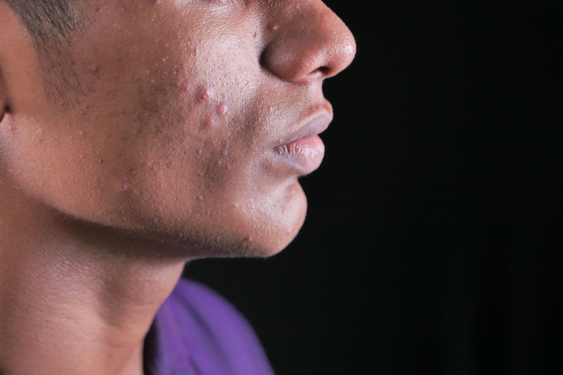 Side view close-up of a young man's face with visible acne on cheek and jawline.