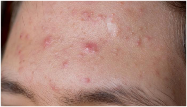 Home Remedies for Acne Scars