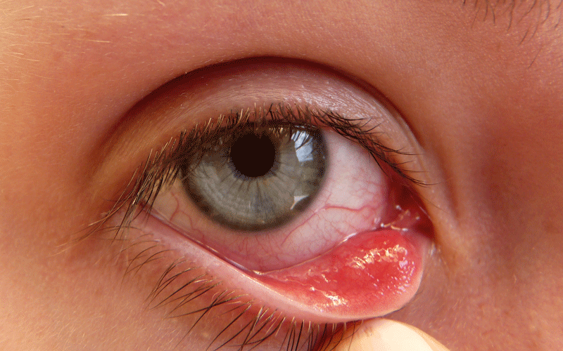 Home remedies for pink eyes