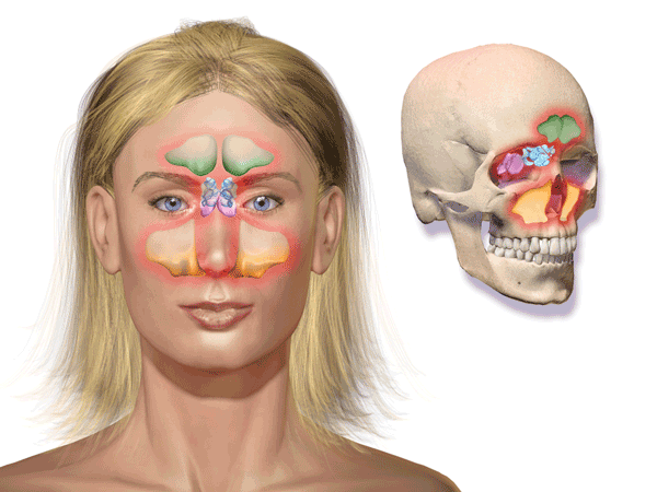 how-to-get-rid-of-a-sinus-headache