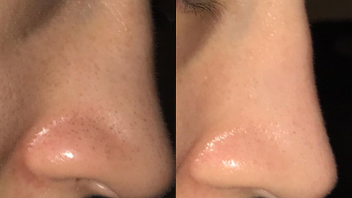 How to Get Rid of Blackheads