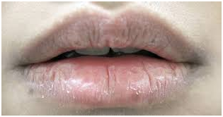 How to Get Rid of Chapped Lips