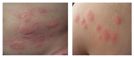 clogged pores - how to get rid of clogged pores