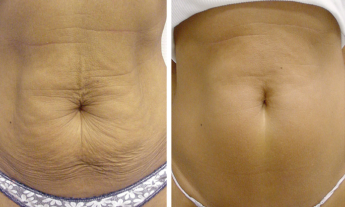 How to get rid of extra skin
