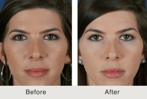 Get Rid of Face Fat