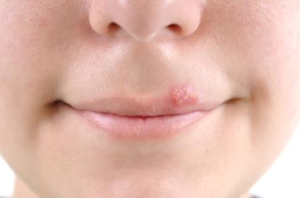 how to get rid of fever blisters