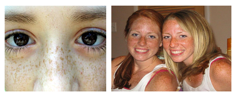 how to get rid of freckles