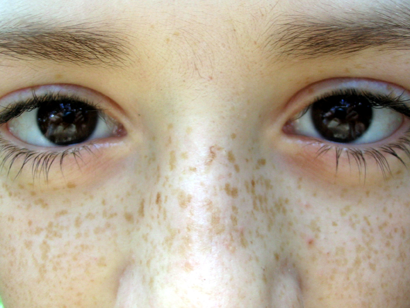 how to get rid of freckles