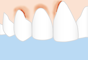 How to get rid of gingivitis fast