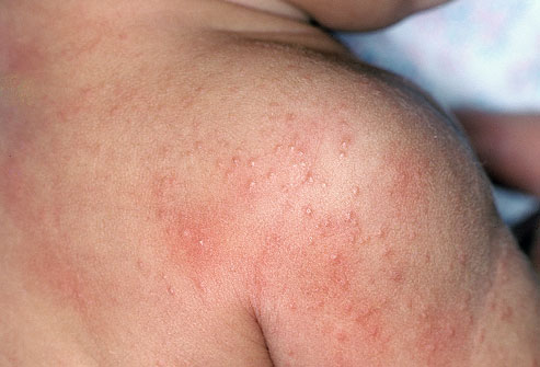How to Get Rid of Heat Rash