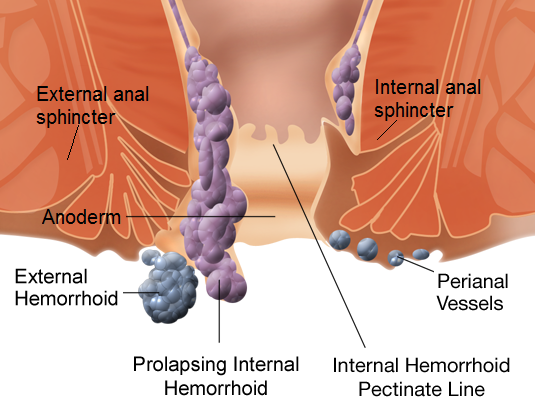 How to Get Rid Of Hemorrhoids Fast Naturally At Home