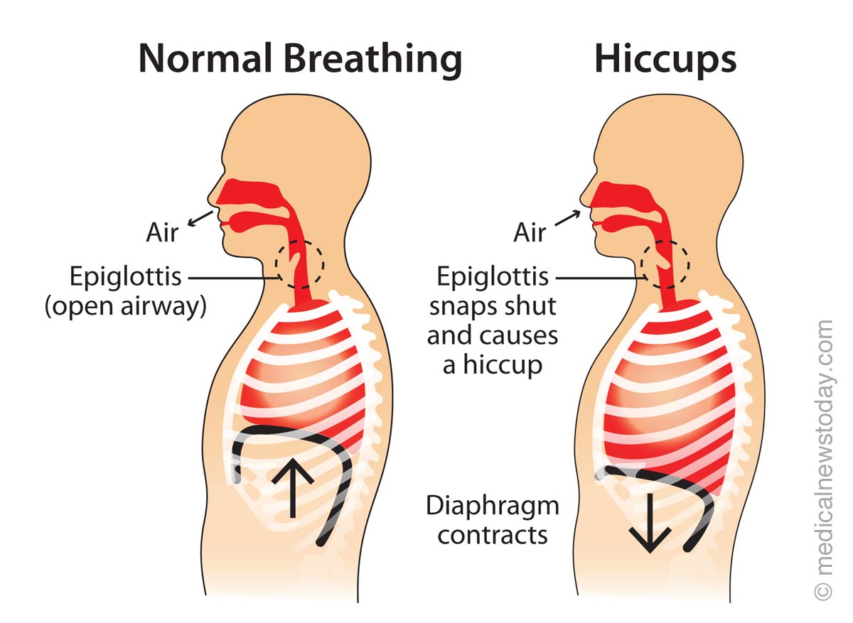How to get rid of Hiccups