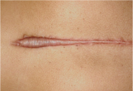 How to get rid of Keloids scars