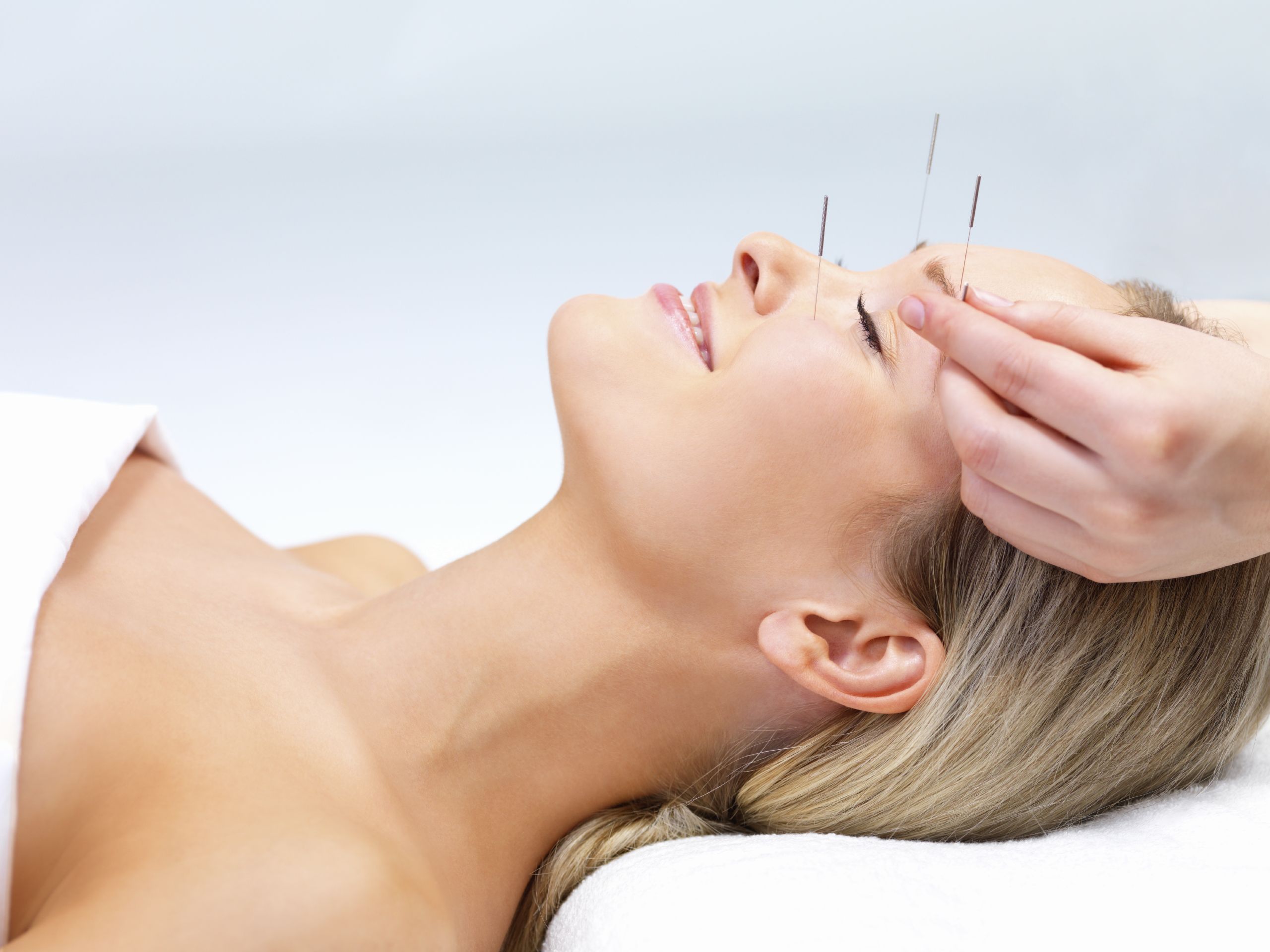 How-to-Get-Rid-of-Migraines-with-Acupuncture