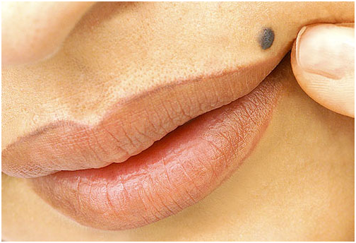 home remedies to remove moles on face