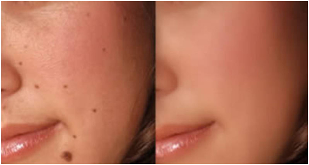 How to get rid of moles on skin