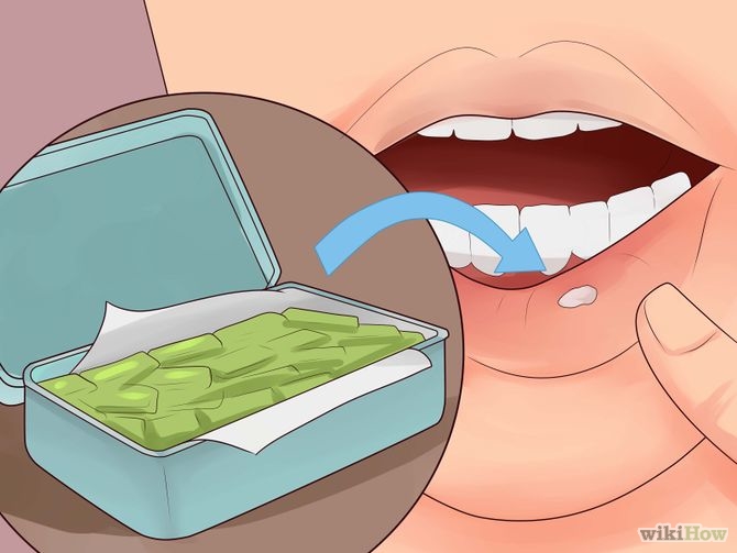 how to get rid of mouth ulcers with The Ice therapy