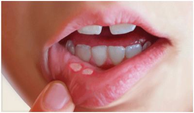 how to get rid of mouth ulcers