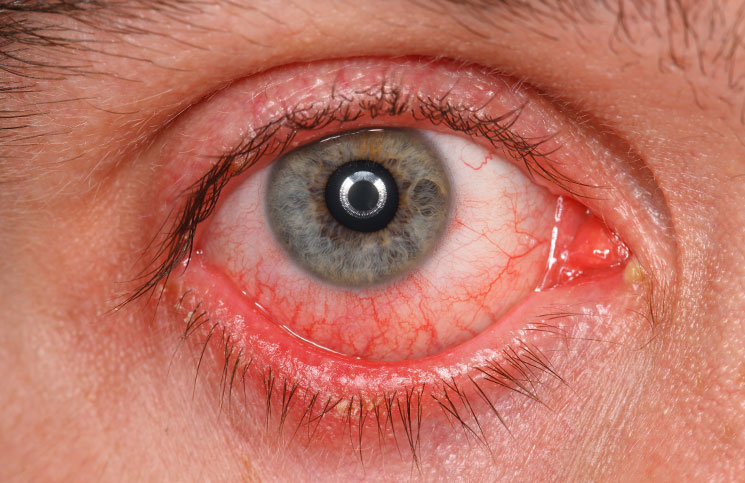 How to Get Rid of Red Eyes