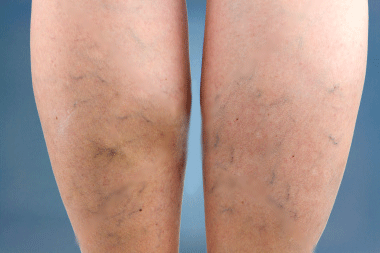 spider veins on face