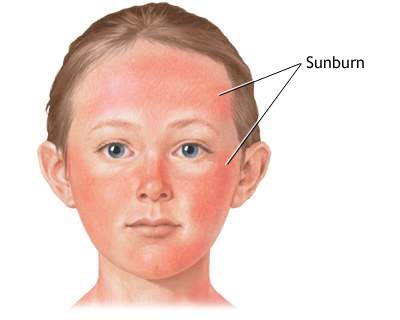 How to get rid of sunburn