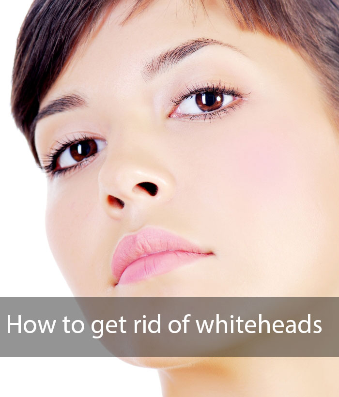 HOW TO GET RID OF WHITE HEADS ON FACE