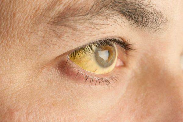 How to get rid of yellow eyes