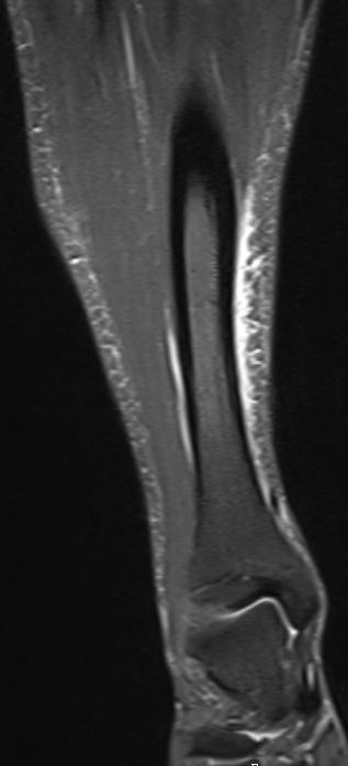 shin splints