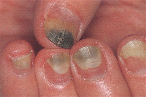 Artificial Nails and Preventing Nail Fungus and its cure