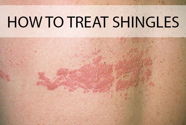 HOW TO TREAT SHINGLES at home NATURALLY