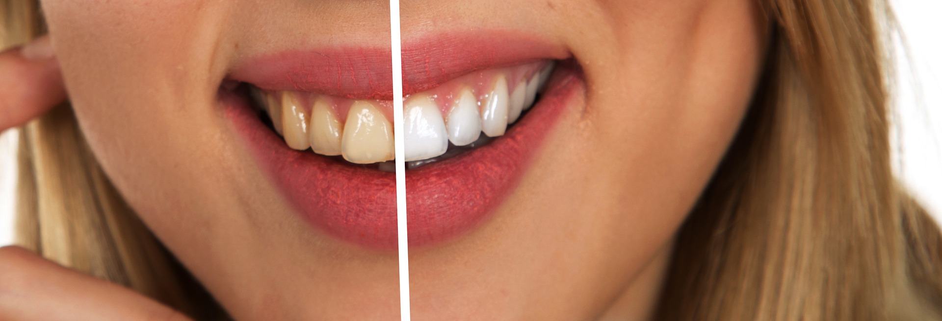 Teeth Whitening Home Remedies. 9 Ways for Perfect smile