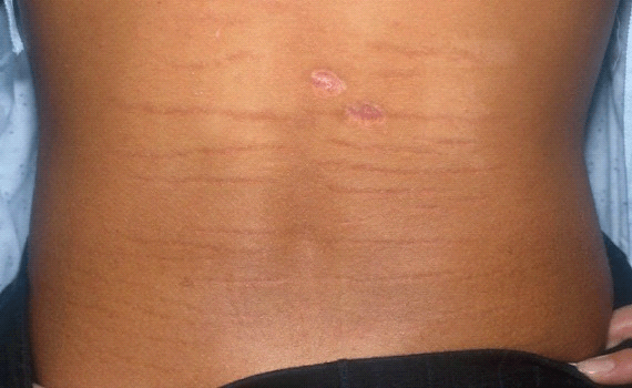 How To Get Rid Of Red Stretch Marks Fast