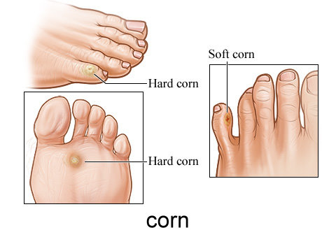 how to get rid of corns on toes