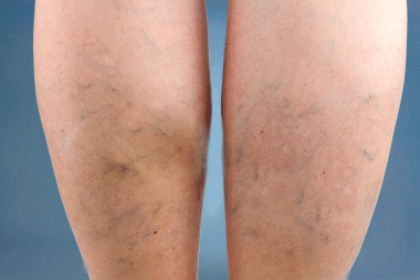 How to get rid of spider veins on legs
