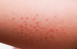 How to Get Rid of Rashes