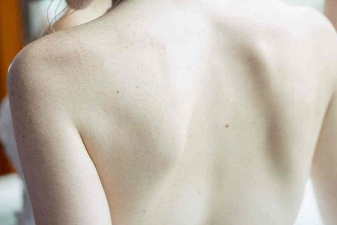 Get rid of back Acne