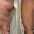 Cellulite Treatments – Ways To Reduce Cellulite